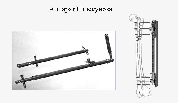 Фиксация кости аппаратом Илизарова